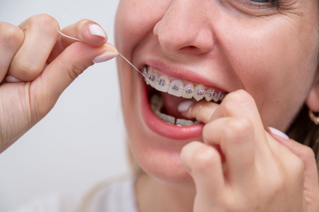 Caring for Your Braces In Between Appointments